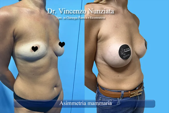 Asimmetria mammaria - paziente 11