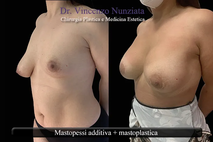 Asimmetria mammaria - Mastopessi additiva + mastoplastica
