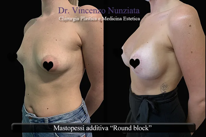 Asimmetria mammaria - Round block