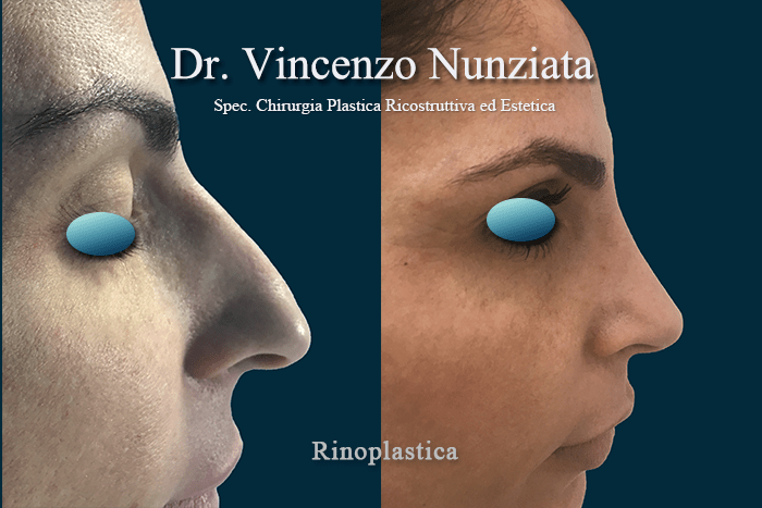 RINOPLASTICA RC