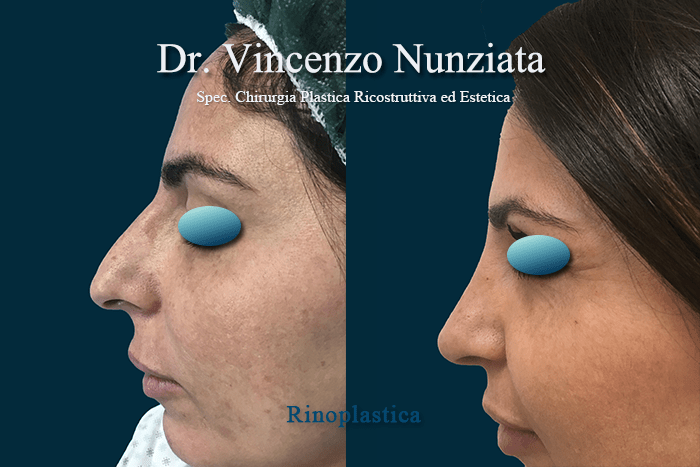 RINOPLASTICA RC 2
