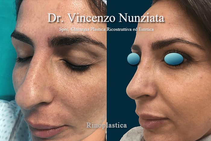 RINOPLASTICA RC 4