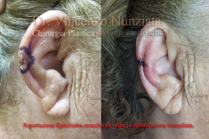 basalioma orecchio