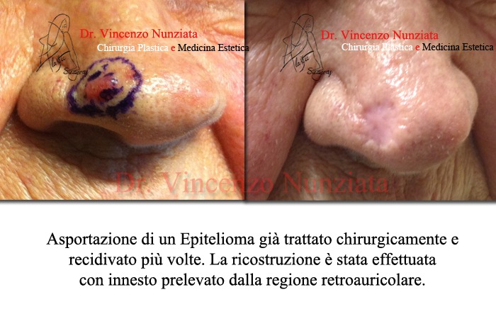 epitelioma calabria
