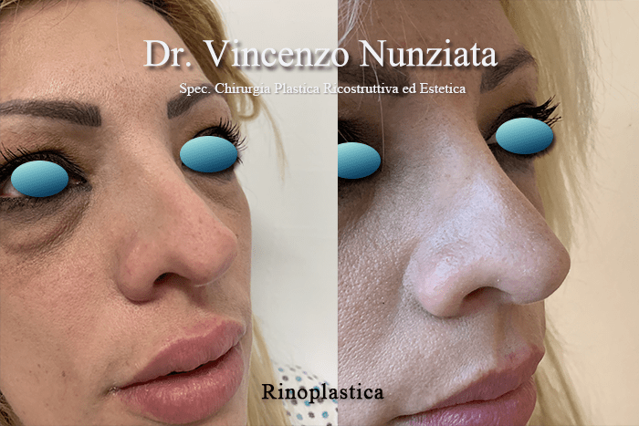 rino catanzaro 3