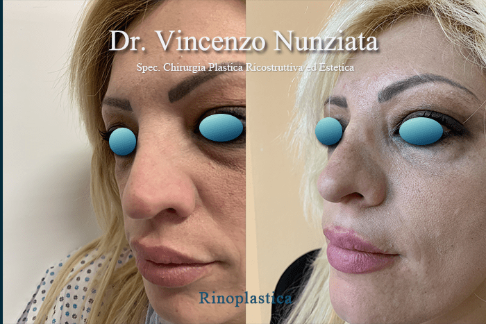 rino catanzaro