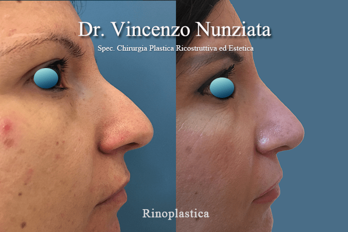 rinoplastica calabria 1
