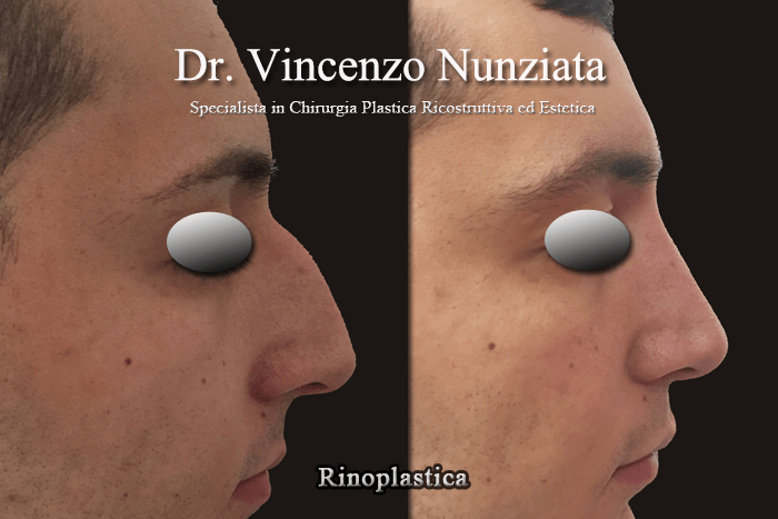 rinoplastica calabria