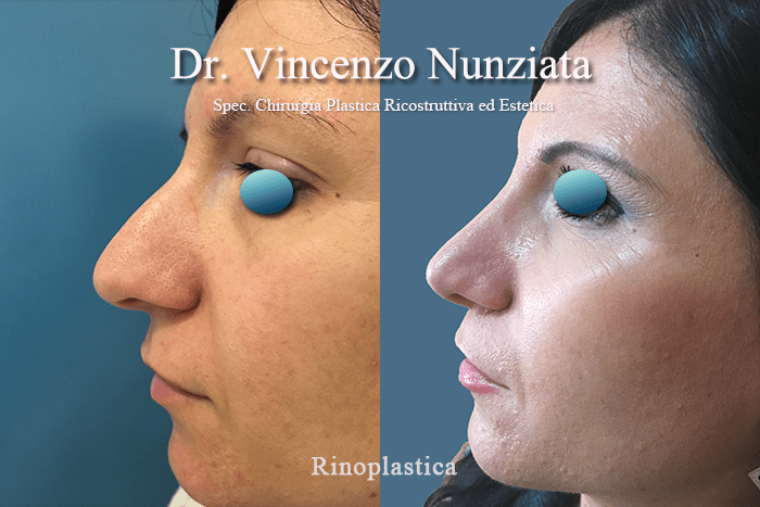 rinoplastica calabria2 1
