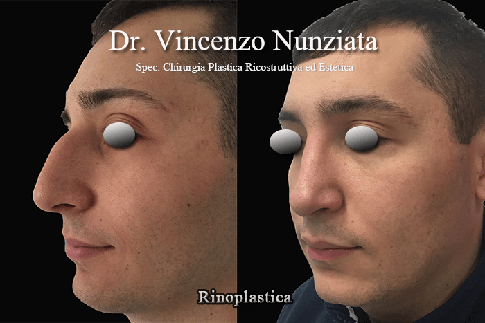 rinoplastica calabria2