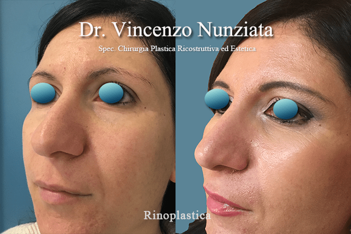 rinoplastica calabria3 1