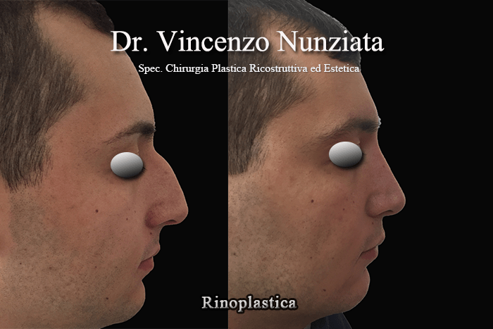 rinoplastica calabria3
