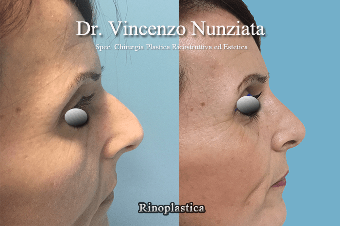 rinoplastica catanzaro3