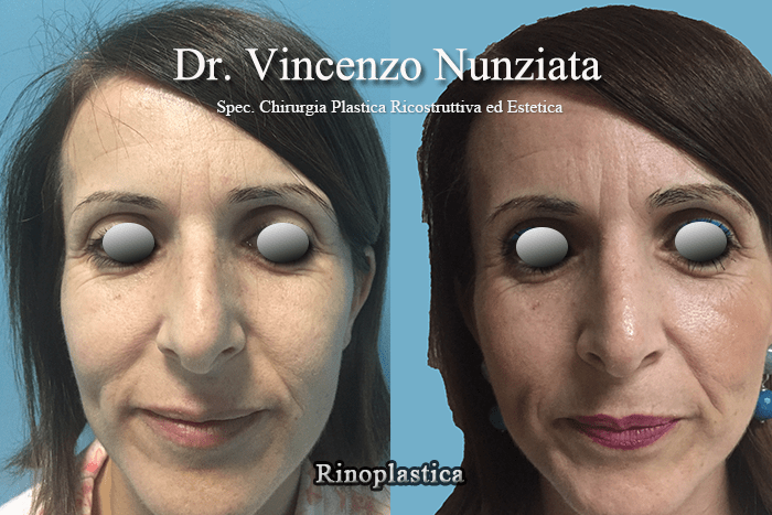 rinoplastica catanzaro4