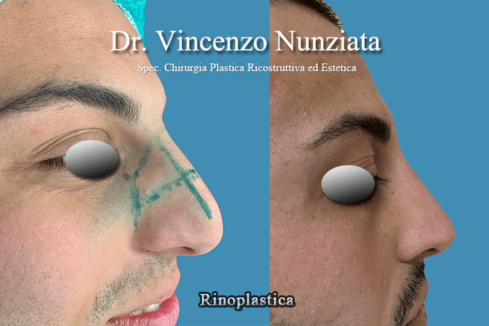 rinoplastica cosenza2