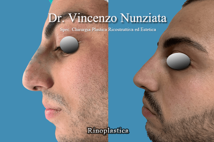 rinoplastica cosenza3