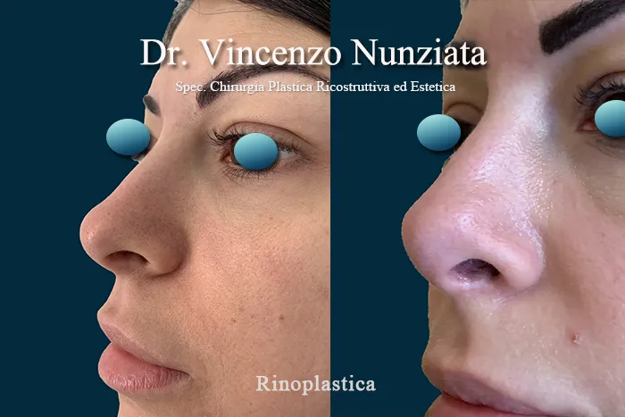 rinoplastica della punta 2