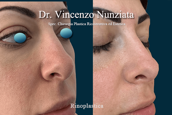 rinoplastica della punta 3
