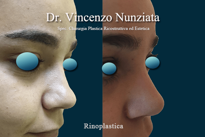 rinoplastica napoli 2
