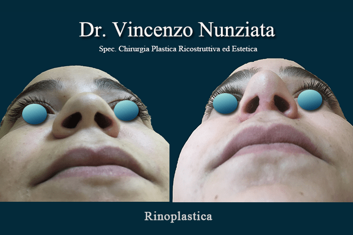 rinoplastica napoli 3