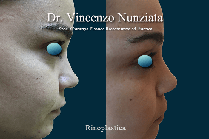 rinoplastica napoli 4