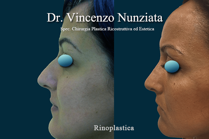 rinoplastica nunziata 2