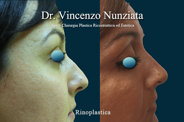 rinoplastica nunziata