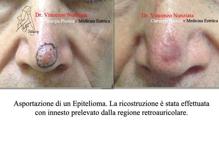 tumore della pelle cosenza