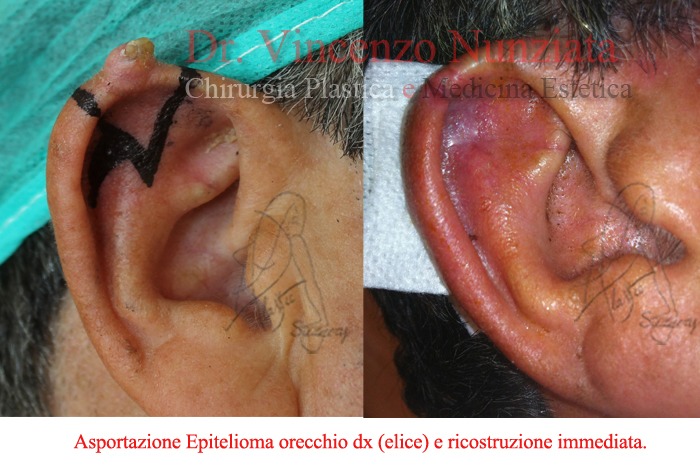 tumore orecchio calabria dx