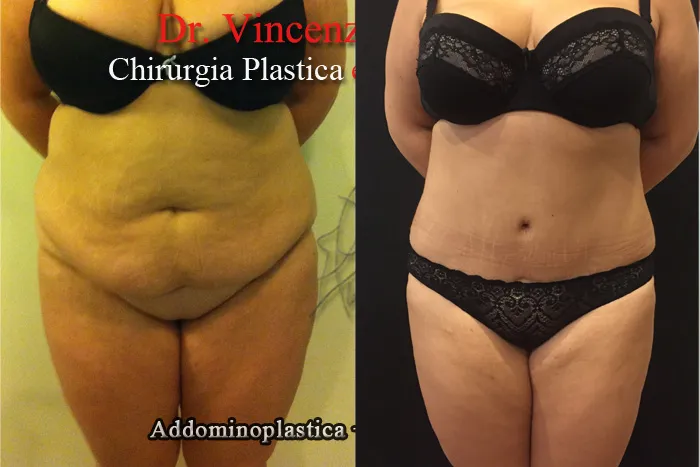 vincenzo nunziata addominoplastica paziente 4 001