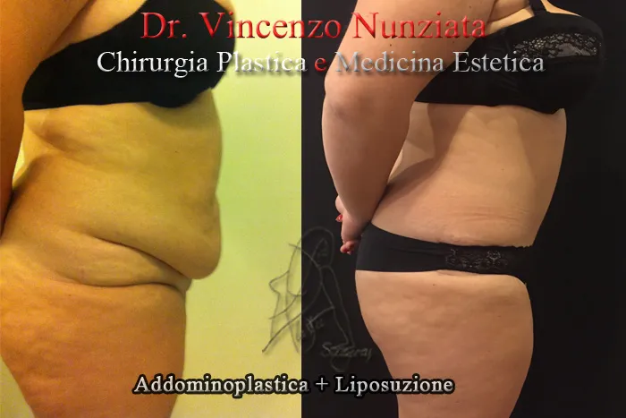 vincenzo nunziata addominoplastica paziente 4 004