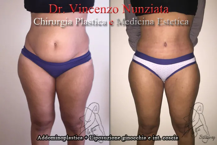 vincenzo nunziata addominoplastica salerno 001