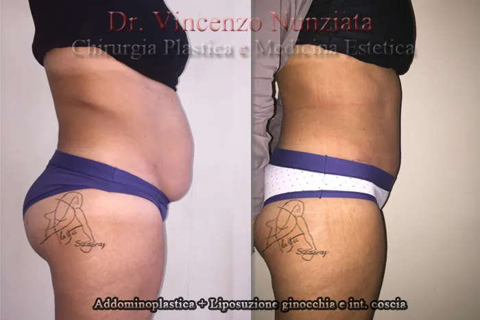 vincenzo nunziata addominoplastica salerno 002