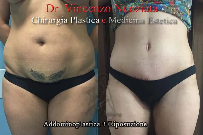 vincenzo nunziata addominoplasticapaziente 3 001