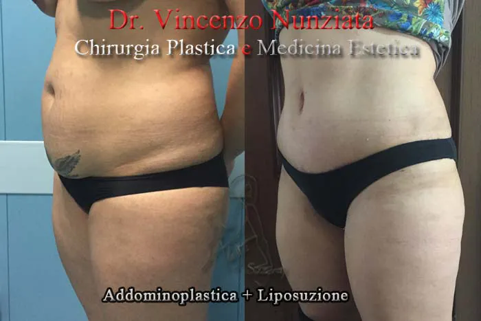 vincenzo nunziata addominoplasticapaziente 3 002
