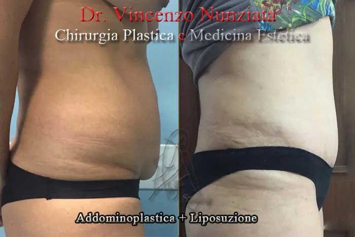 vincenzo nunziata addominoplasticapaziente 3 003