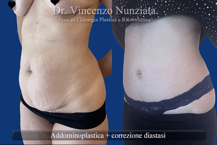 addomino plastica 3