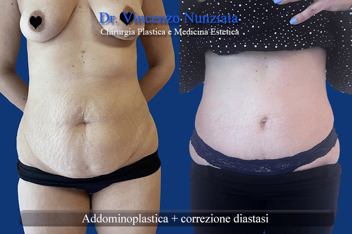 addomino plastica
