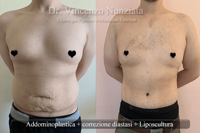 addominoplastica caserta 1