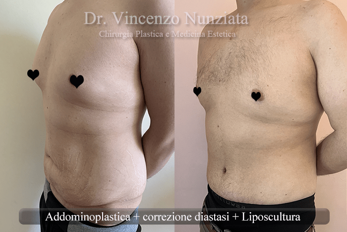 addominoplastica caserta 2
