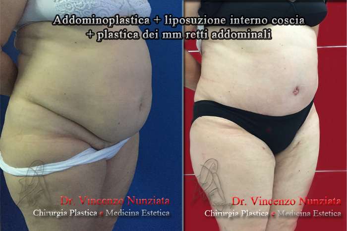 addominoplastica cosenza2