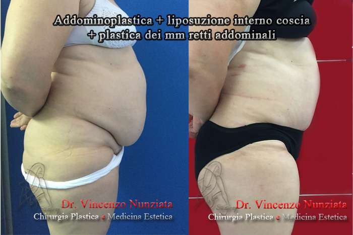 addominoplastica cosenza3