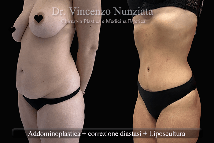 addominoplastica e liposcultura 2