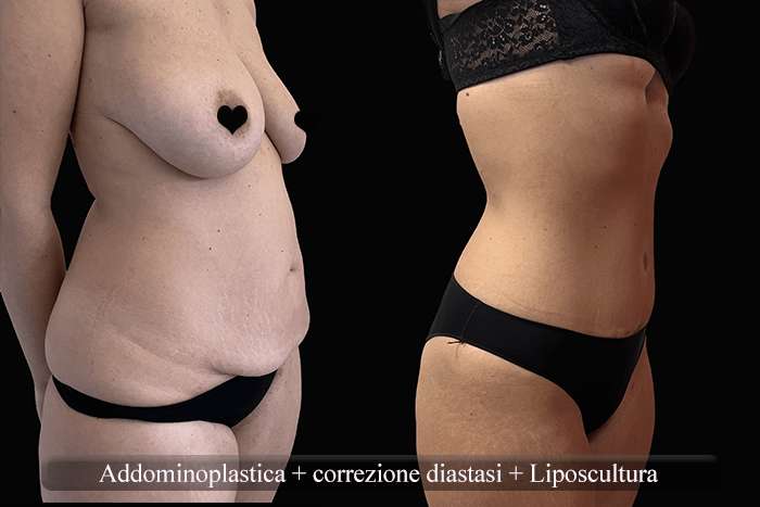 addominoplastica e liposcultura 3