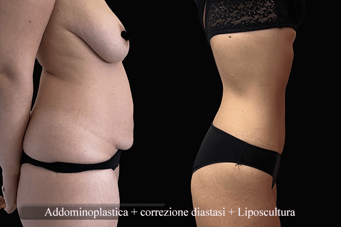 addominoplastica e liposcultura 4