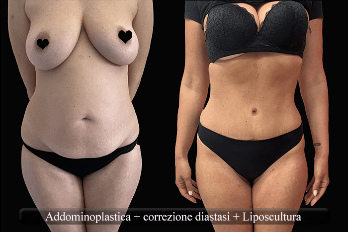 addominoplastica e liposcultura
