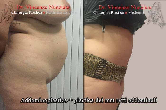 addominoplastica napoli dx
