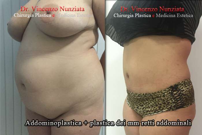 addominoplastica napoli sx