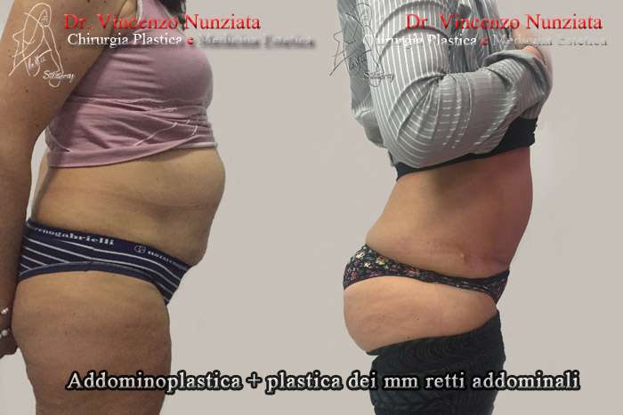 addominoplastica nunziata dx