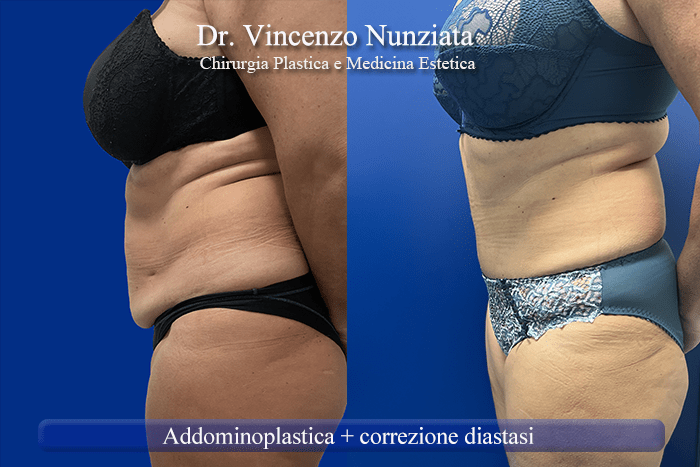 addominoplastica roma 3